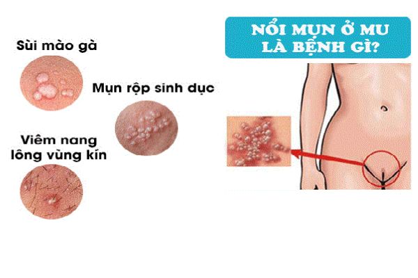 noi-mun-vung-long-mu-phai-lam-sao-01